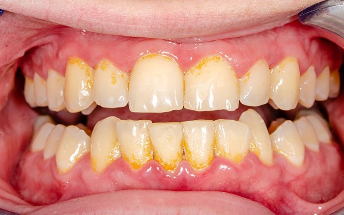 Wie entsteht Zahnstein? Was passiert in welcher Phase?